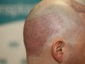 Greffe de cheveux FUE : la solution moderne contre la calvitie, expliquée simplement