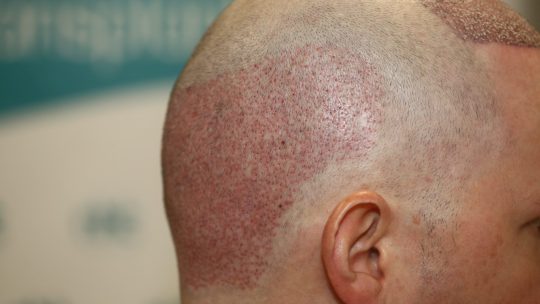 Greffe de cheveux FUE : la solution moderne contre la calvitie, expliquée simplement
